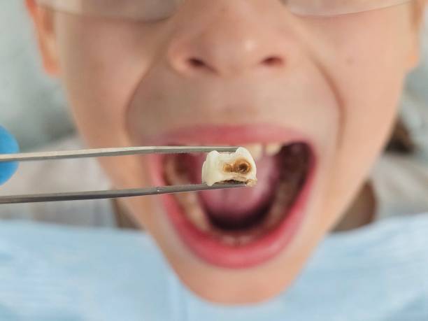 Best Emergency Root Canal Treatment in Lineville, AL