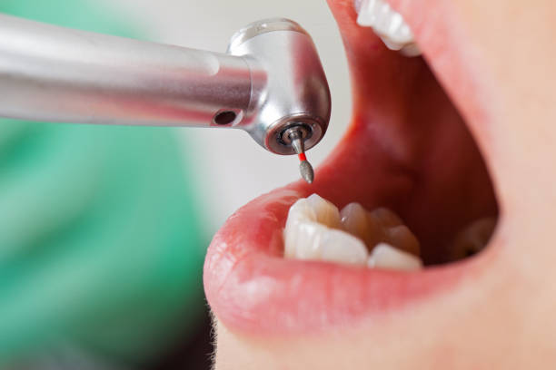 Best Emergency Dentist for Lost Fillings or Crowns in Lineville, AL